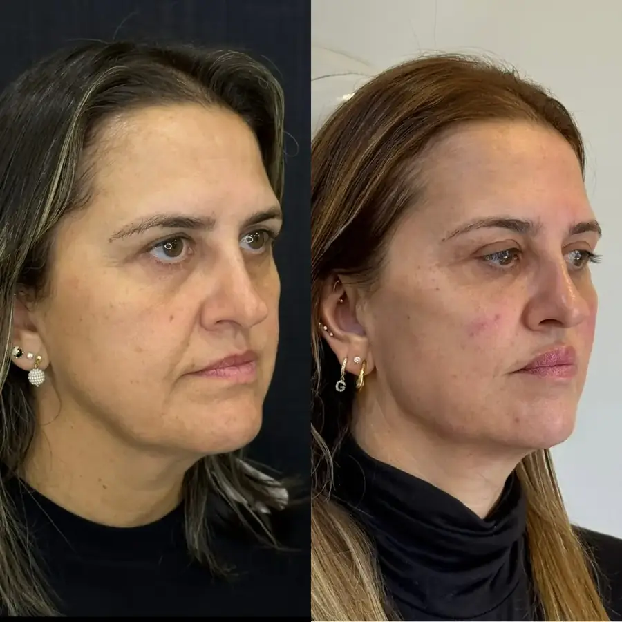 Antes e depois 4